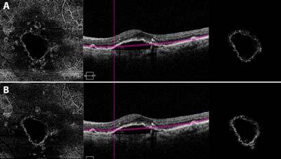 Actually reflectance of inner retinal vasculature on the edges of the PED