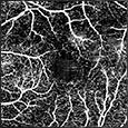 encoded image Deep scan revealing CNVM below the RPE Superficial Retinal Layer over FA B Scan from OCT RETINA, THE JOURNAL OF