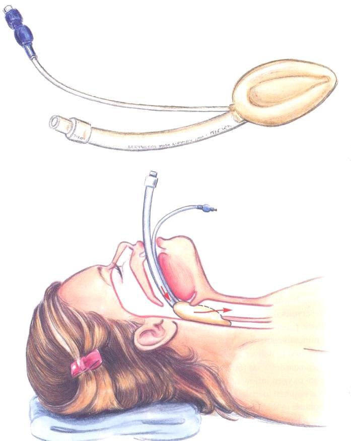 Laryngeal Mask Higher success rate Does NOT protect