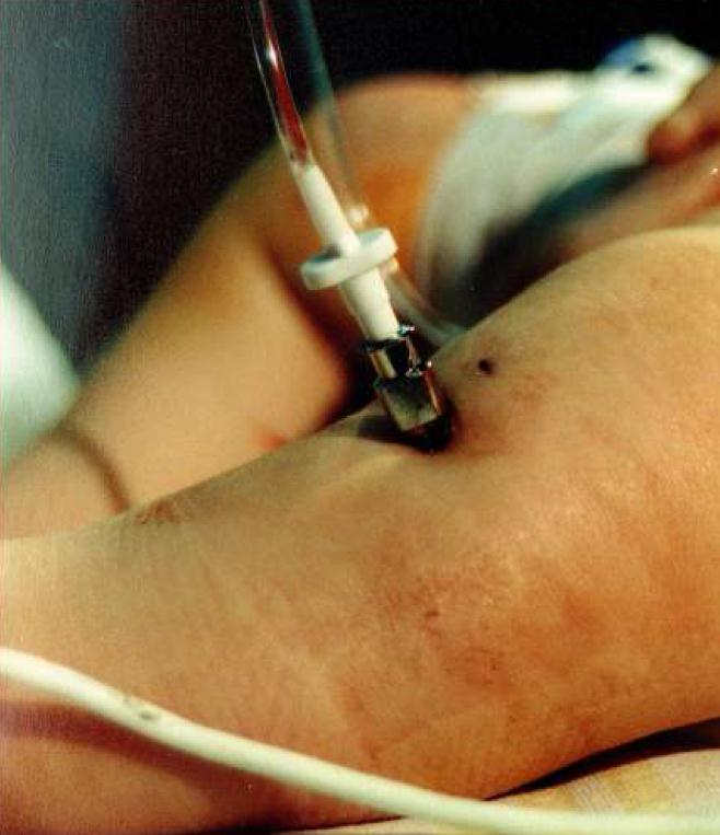 Intraosseous line (IO) a rapid and safe alternative when peripheral venous access is