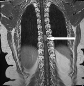 the Lesion Figure 3f Figure 3a b, c, d, e, f. MRI Images.