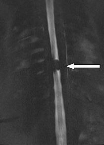 Side. (c) Sagittal T2WI; the Lesion is Iso to Mildly Hyperintense.