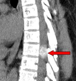 (e) Axial T2WI showing Lesion in the Spinal Canal obscuring the CSF Space.