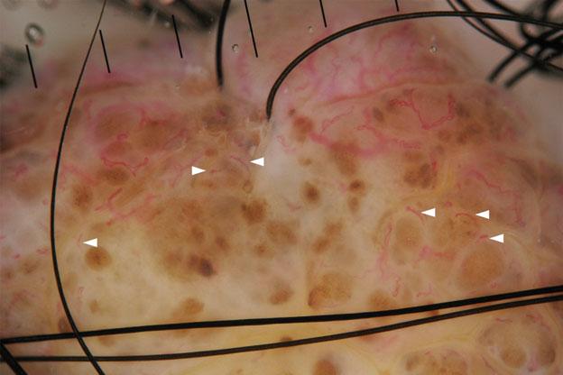 Comma vessels in a dermal nevus. Various sizes of comma vessels can be seen. Figure 5. Dotted vessels in a melanoma. Many dotted vessels are seen in the depigmented area for regression.