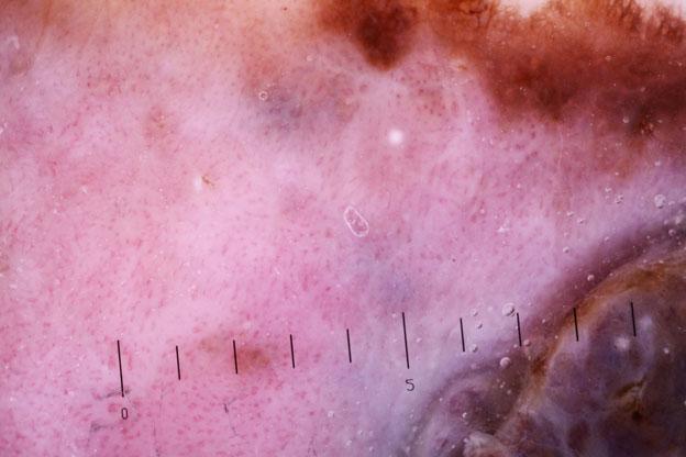 13) are structures relatively diagnostic of actinic keratosis and thick AHM, respectively.