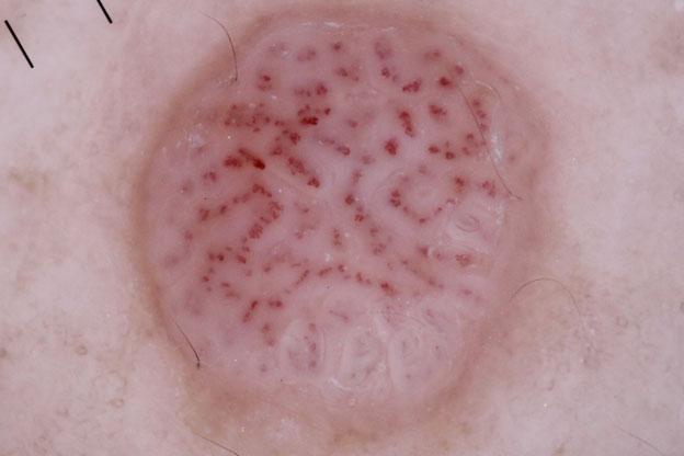 Pearls on a string or serpiginous pattern vessels in the nodule suggest a clear cell acanthoma.