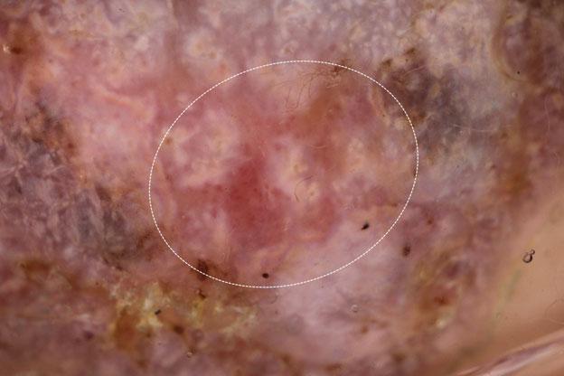 Milky red areas/globules in a hypomelanotic melanoma. Milky red areas/globules are a specific clue for thick melanoma (white dotted circle).