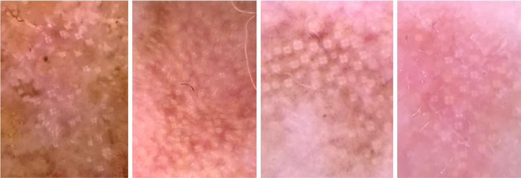 2). The pigmented dermoscopic features were pigmented pseudonetwork (Fig. 3) in 18 (32.1%), multiple grey to brown dots and globules around hair follicles (Fig.