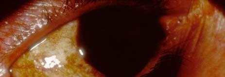 Benign Epithelial Pigmented Tumors Ophthalmic Pathology Describes Melanocytic Lesions to Arise from 3 Types of Melanocytes Pigmented seborrheic
