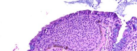 Fusiform dendritic melanocytes that lie in the deeper mesenchymal or subepithelial tissue Congenital Melanosis Benign Epithelial Melanosis -
