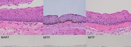 PAM Histology PAM 1 without atypia (overproduction of Melanin with hyperplasia)