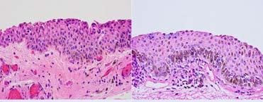 epithelium ( not considered premalignant) PAM 2 with atypia Examine for