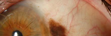 Malignant melanoma of the Conjunctiva 1. Melanoma with PAM (75%) 2. Melanoma without PAM (25%) Note: 25% of all lesions have evidence of preexisting nevus 3.