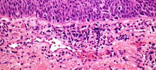 Sinonasal mucosal melanoma Sinonasal mucosal melanoma Age: 30-90 years (median 71) M-F ratio 3:2 Follow up p( (31 pts): 5 to 211 months (mean 42) 58% died of melanoma associated conditions 19% died