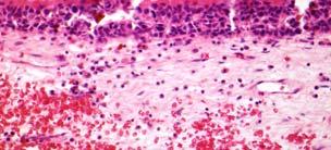 Hyperplasia and atypia, not MMIS Mochel et al: Melanocytes within