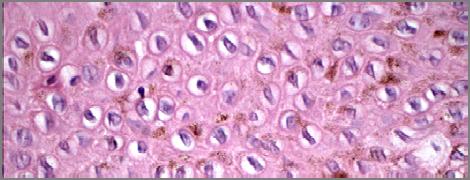 hyperplasia (precursor lesion to melanoma) Mucosal
