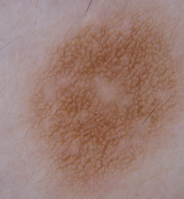 Pigment network Consists of pigmented