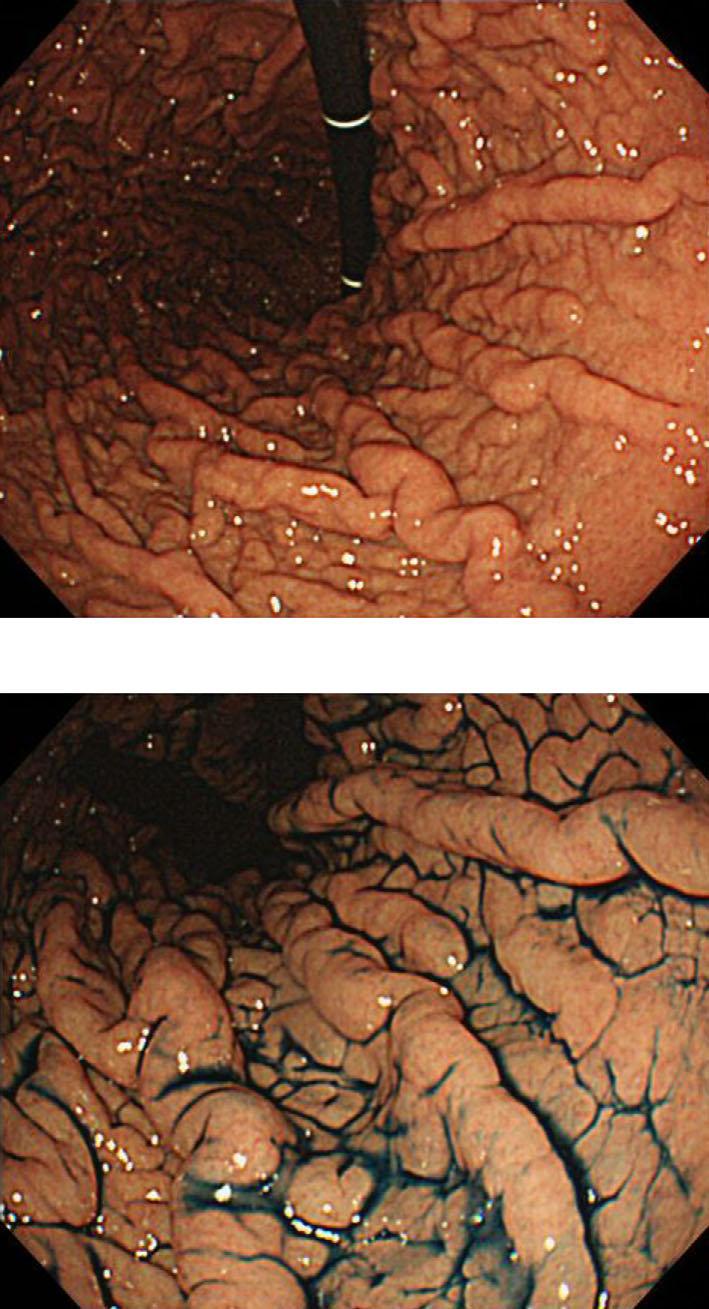 A B Figure 1. Endoscopic appearance of gastric cobblestone-like lesions (GCLLs) in the gastric corpus. A: Endoscopic examination shows GCLLs.