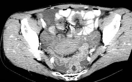 CT of ovarian metastasis from