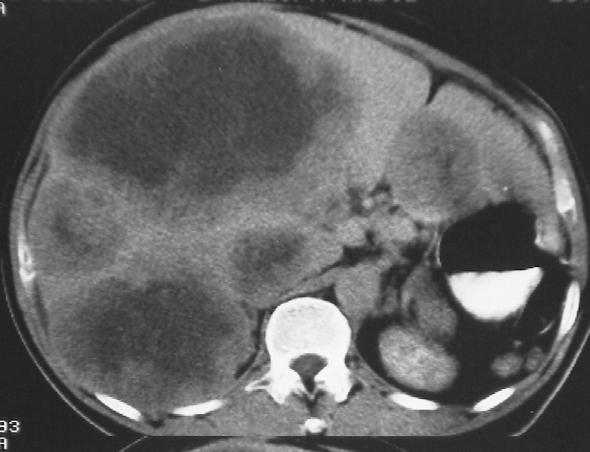 CT shows an unresectable gastric mass ( )