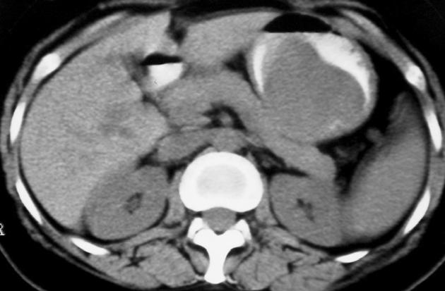 gastric stromal tumor in a