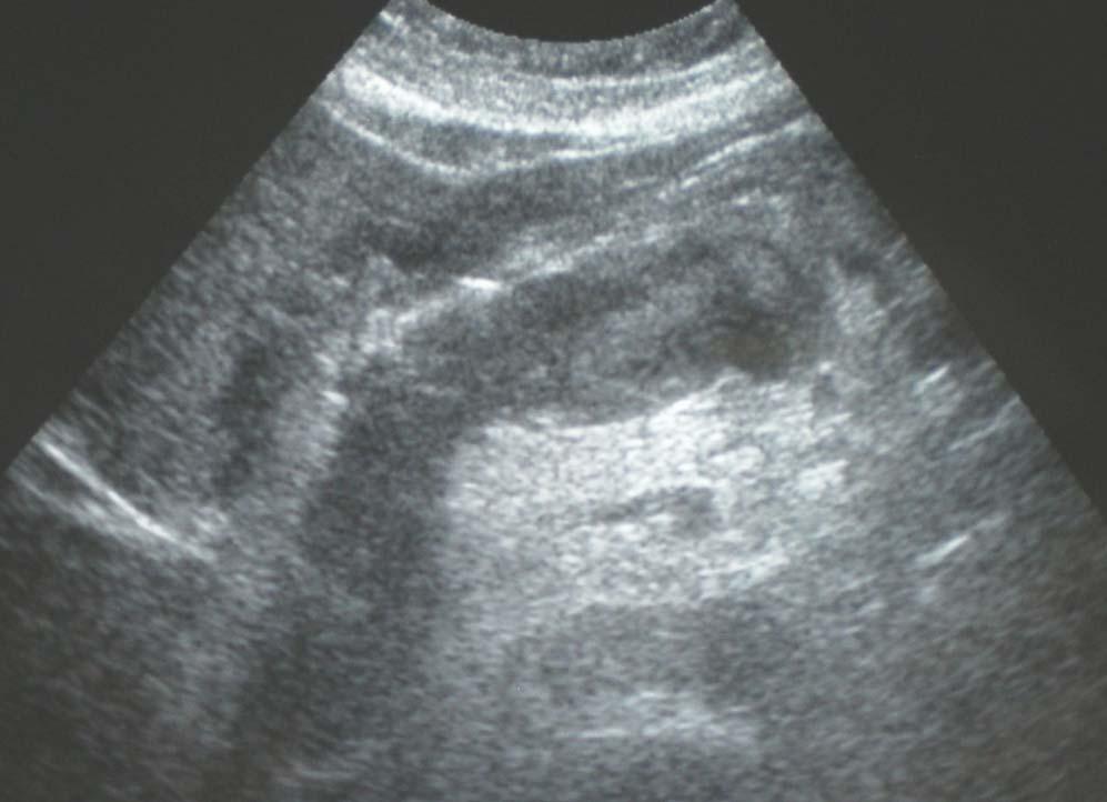 L P A 67 years old woman presented with abdominal pain and vomiting.