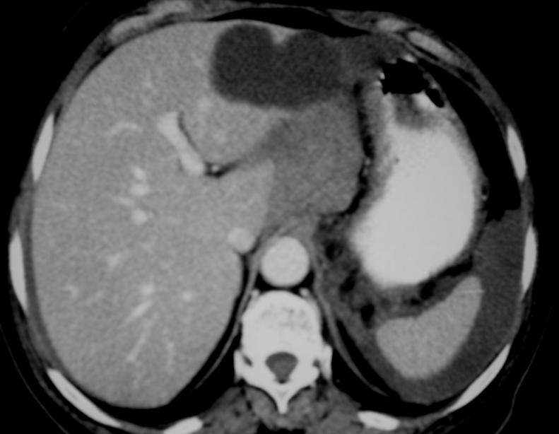 CT shows gastric mass ( ) and a second mass