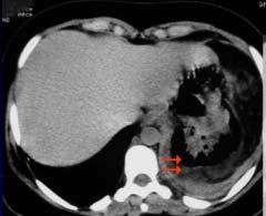 CT shows gastric pneumatosis( ).