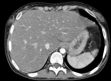 Adenocarcinoma in43 years old