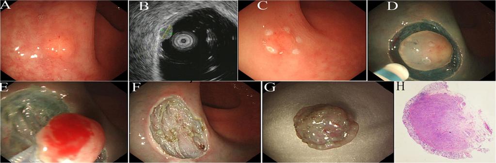 Figure -1Endoscopic mucosal resection with circumferential incision of a rectal carcinoid tumour.