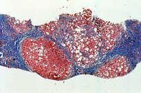 OF STEATOSIS AND STEATOHEPATITIS Fat Accumulation in the Liver Increased fatty acid