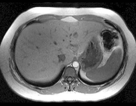 Detecting the Presence of Steatosis Steatosis on MRI Bright liver Echotexture - increased compared to kidney Advantages: Widely available Inexpensive Painless Limitations: Lacks sensitivity Requires