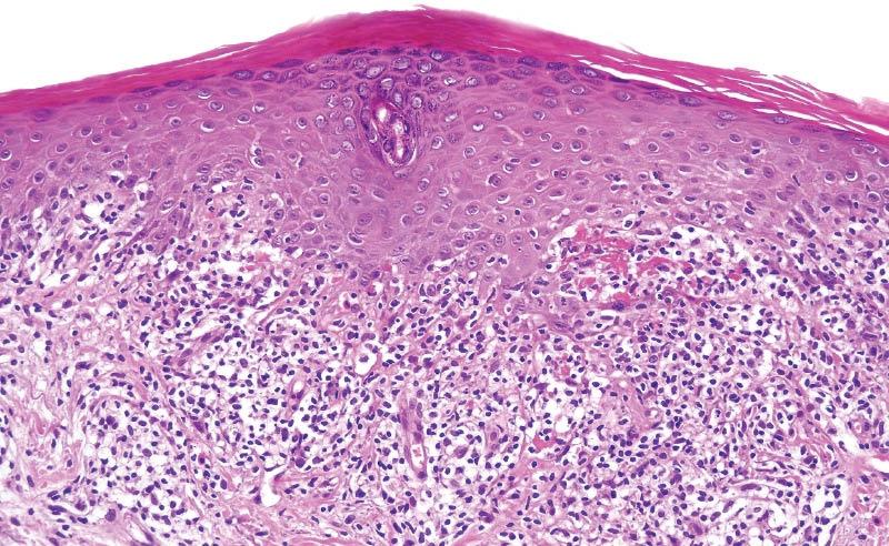 Lichenoid Dermatitis Interface Dermatitis Band-like infiltrate that hugs the dermoepidermal