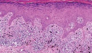 ) Band-like inflammatory Infiltrate Civatte bodies Wedge-shaped hypergranulosis Saw-tooth rete