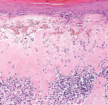 Consider Lichen Planus-like Keratosis (LPLK) Lichen Sclerosus Predilection for anogenital skin