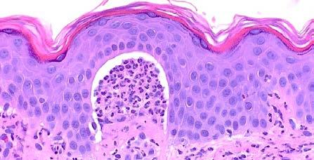 DEJ Subepidermal cleft with abundant Eosinophils Dermatitis Herpetiformis Subepidermal split