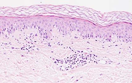 underlying basket-woven stratum corneum (dermatophytes located in between) Morbilliform Drug Reaction Histologic findings are nonspecific