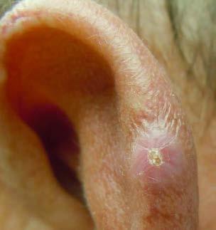 infiltrates Chondrodermatitis nodularis helicis (CNH) Lesion of outer helix of ear that is usually result of trauma; Clinically