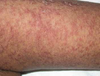 Idiosyncratic and potentially serious cutaneous adverse drug reactions (CADRs), although relatively rare, account for significant morbidity and mortality.