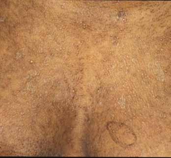 On withdrawal of the offending drug the lesions usually resolve spontaneously, sometimes with post-inflammatory hyperpigmentation.