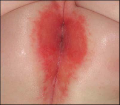 Diaper Dermatitis Perianal Strep: GroupAStrep Sharply demarcated, painful/pruritic, erythematous,