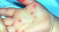 Coxsackie: Hand, Foot, Mouth Painful red lesions, high fever, drooling, flu-like