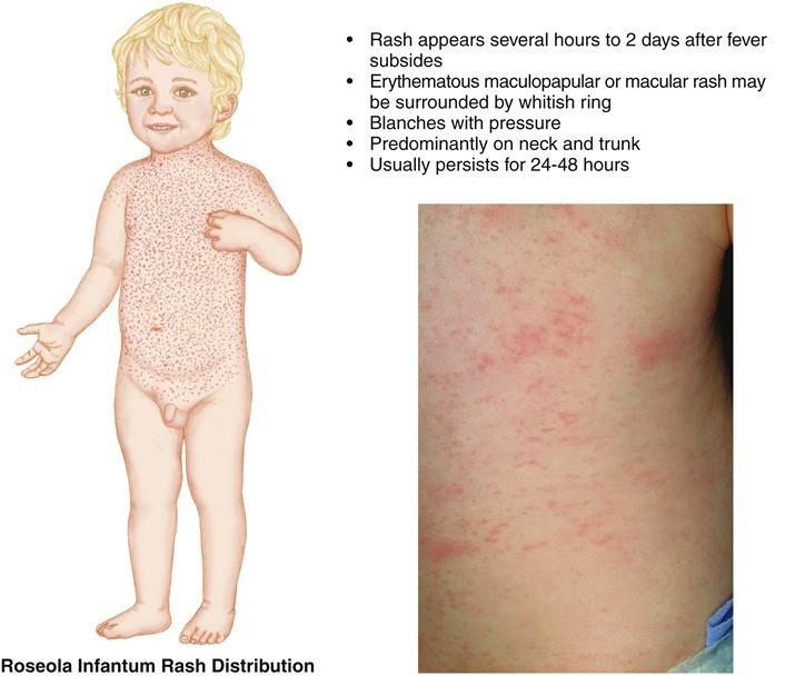 Roseola (HHV): Sixth disease 6months 2yrs 3-5 days HIGH fever Abrupt