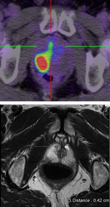 PET/MRI Role of pre operative PET CT Identify distant disease in high risk