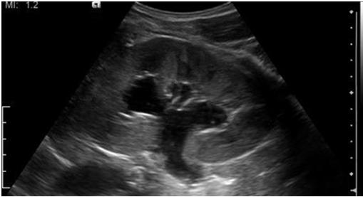 Hydronephrosis Scan for Ureteral Jets of
