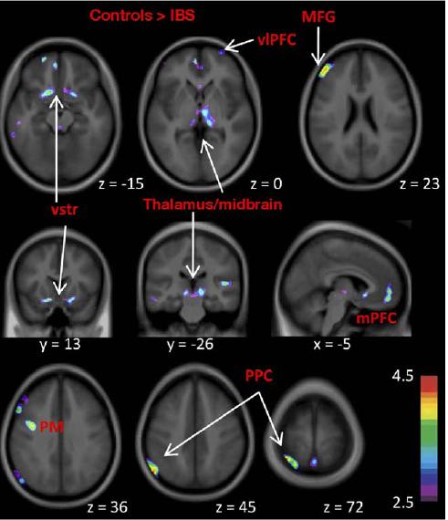 Decreased Regional Gray Matter Density in Patients with IBS Medial prefrontal cortex