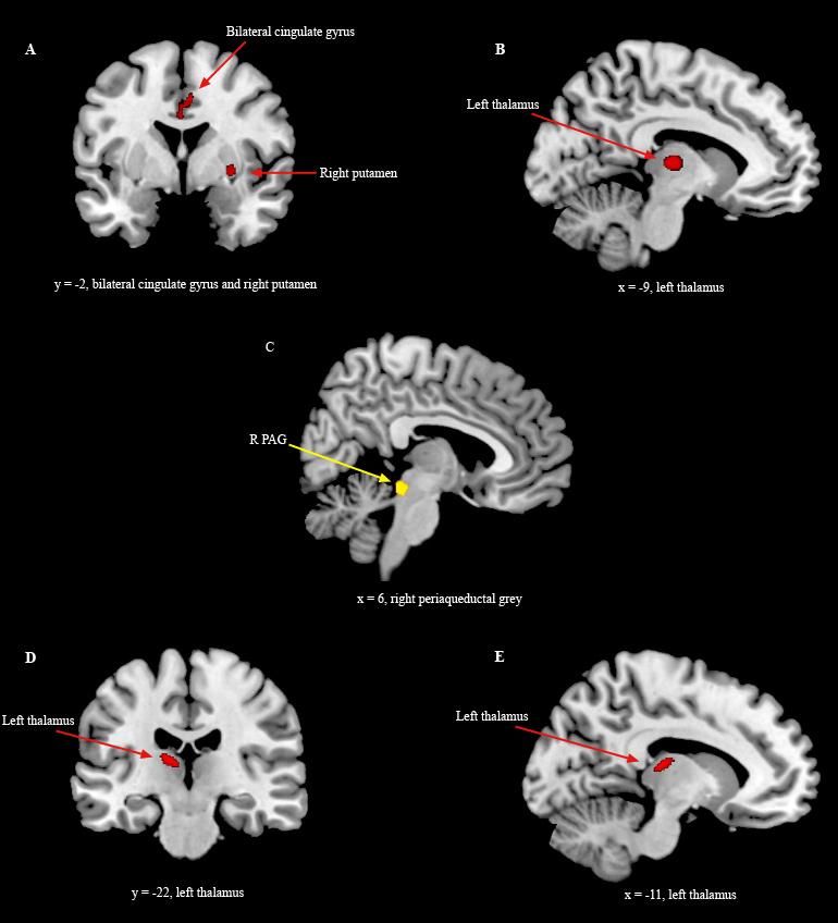 Increased Regional Gray Matter Volume in Women with Endo Pain Endo Pain vs.