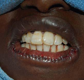 Gingival lesions may present with loosening teeth or as a non-healing ulcer after a tooth extraction.