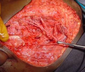 Macrocystic lesions (made up of large cysts which are more easily identifiable) have a much better prognosis whether managed surgically or medically.