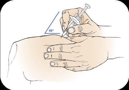 Hold firmly. Use a quick, dart-like motion to insert the needle into the pinched skin at a 45 angle (see Figure 8).